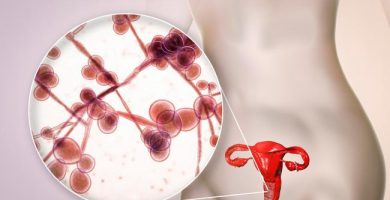 Candidiasis vaginal- Qué es, Síntomas, Causas y Tratamiento