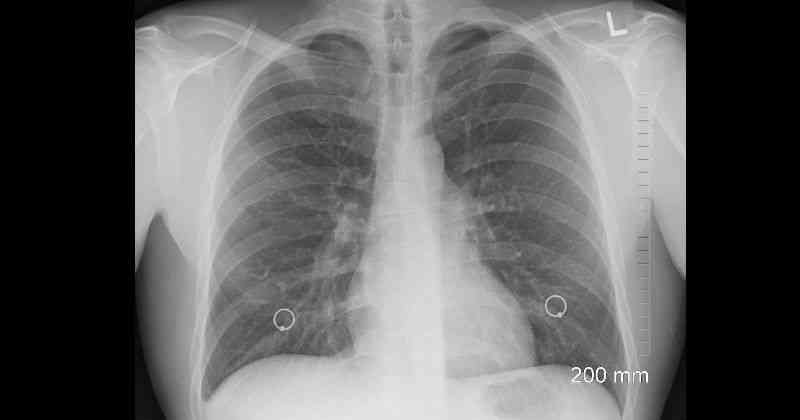 Cáncer de pulmón: ¿Qué es y qué lo causa?