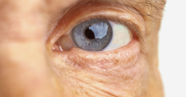 Degeneración macular asociada con la edad: ¿Qué es y cómo prevenirla?
