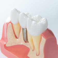 Implantesdentales 2 Implantes Dentales: ¿Qué Son Y Cuánto Cuestan?