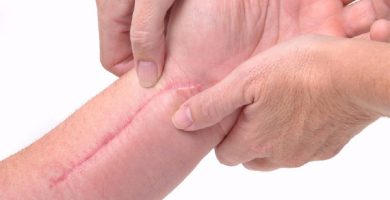 ¿Cuál es la mejor crema para cicatrizar heridas?