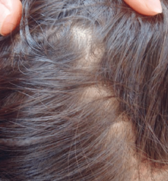 ¿Qué medicamento es bueno para eliminar los piojos?