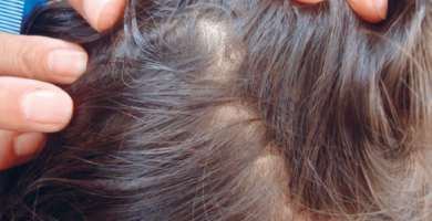 ¿Qué medicamento es bueno para eliminar los piojos?