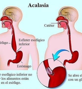 Acalasia: ¿Qué es?