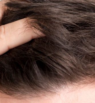Alopecia: ¿Qué es, cómo tratarla y qué la causa?