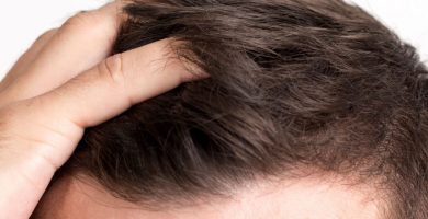Alopecia: ¿Qué es, cómo tratarla y qué la causa?