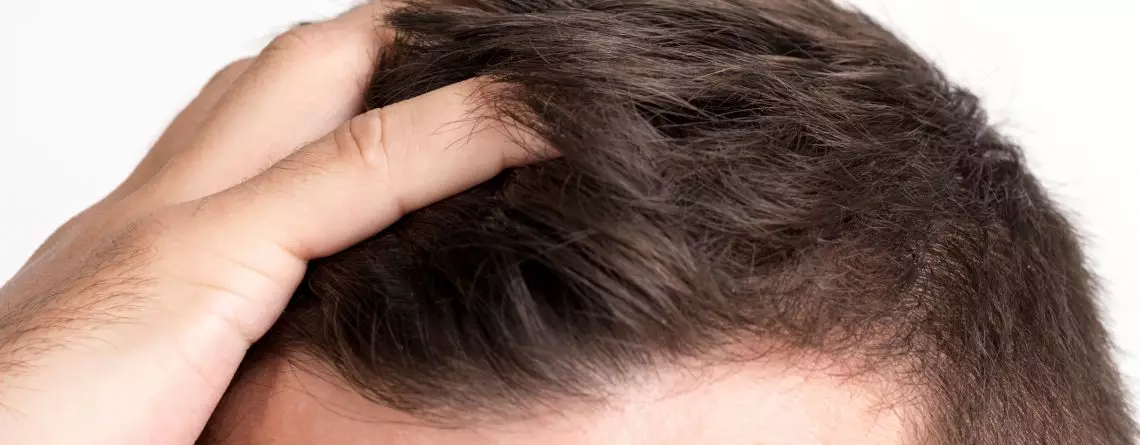 Alopecia: ¿Qué es, cómo tratarla y qué la causa?