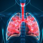 Bronquiectasia: ¿Qué es?