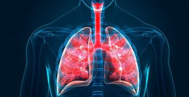 Bronquiectasia: ¿Qué es?