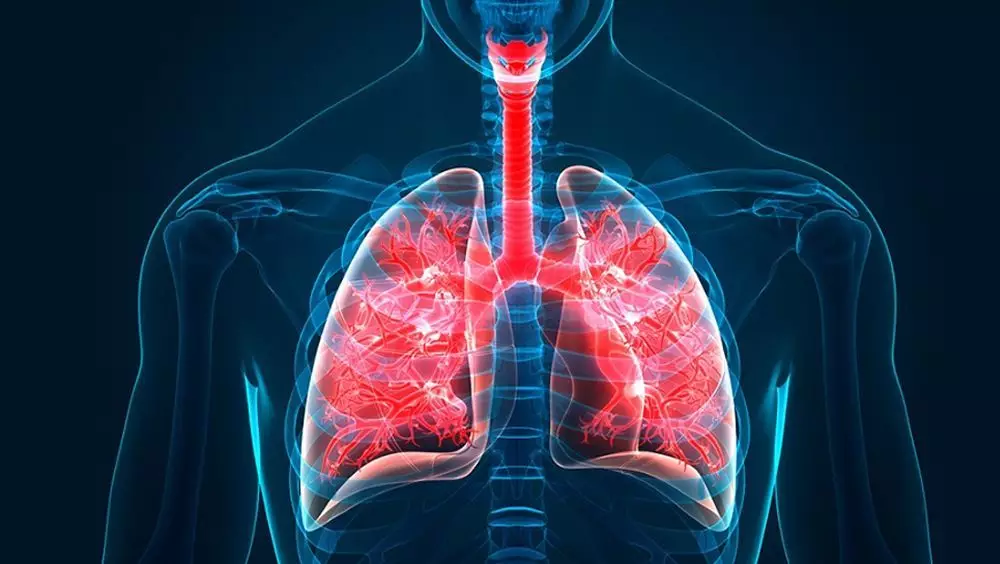 Bronquiectasia: ¿Qué es?