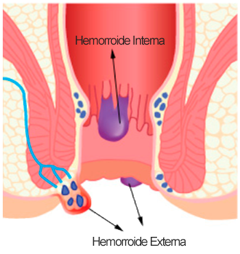 Hemorroides: Qué son, Síntomas, Causas y Tratamiento