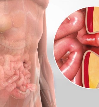 Hernia: ¿Qué es?