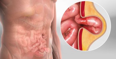 Hernia: ¿Qué es?