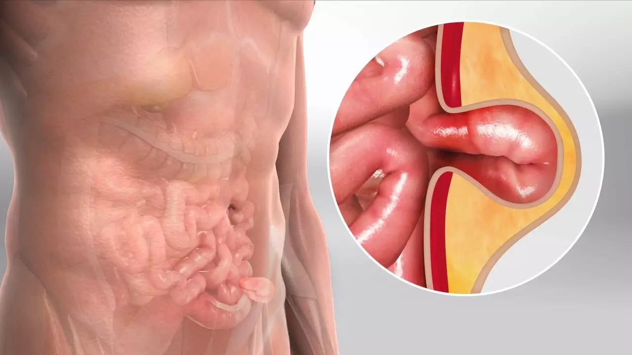 Hernia: ¿Qué es?