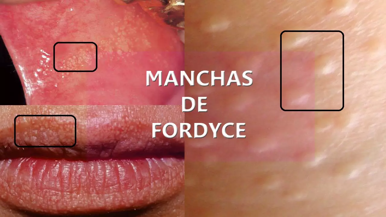 Manchas de Fordyce: ¿Qué es?