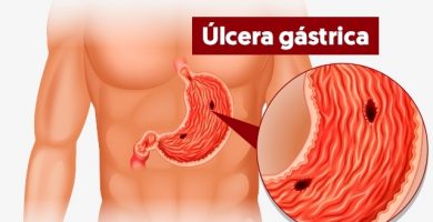 Úlcera gástrica: ¿Qué es?