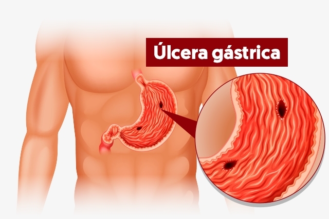 ▷ Úlcera gástrica: ¿Qué es? - Todo sobre medicamentos