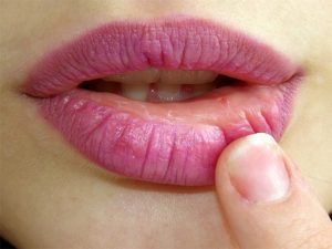 Fuegos labiales- Qué son y cómo eliminarlos
