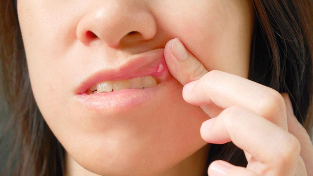 Fuegos labiales: Qué son y cómo eliminarlos