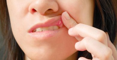 Fuegos labiales: Qué son y cómo eliminarlos