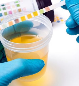 Examen general de orina: ¿Qué es y para qué sirve?