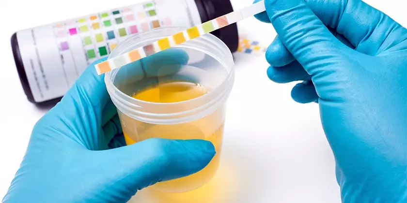 Examen general de orina: ¿Qué es y para qué sirve?