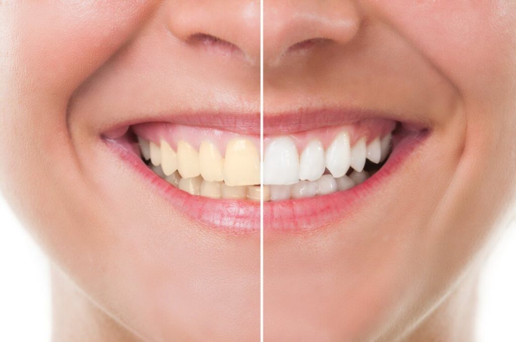 Blanqueamiento Dental: ¿Qué es y para qué sirve?