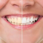 Blanqueamiento Dental: ¿Qué es y para qué sirve?