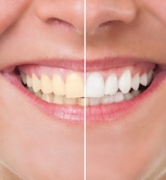 Blanqueamiento Dental: ¿Qué es y para qué sirve?