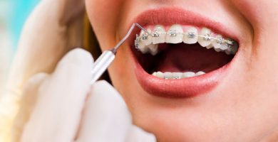 Brackets tradicionales: ¿Qué son y para qué sirven?
