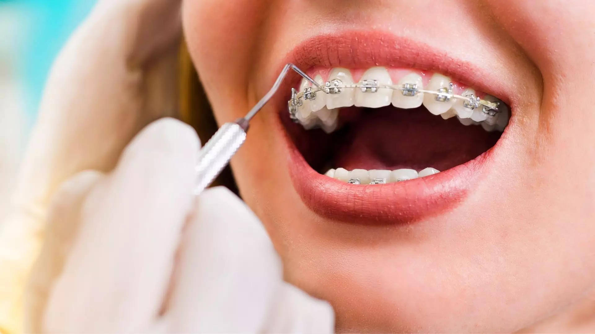 Brackets tradicionales: ¿Qué son y para qué sirven?