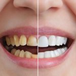 Carillas Dentales: ¿Qué son y para qué sirven?