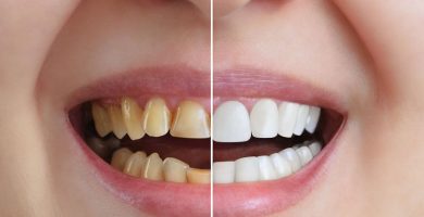 Carillas Dentales: ¿Qué son y para qué sirven?