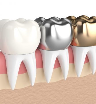 Coronas Dentales: ¿Qué son y para qué sirven?