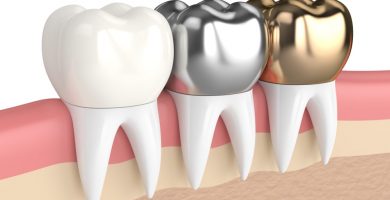 Coronas Dentales: ¿Qué son y para qué sirven?
