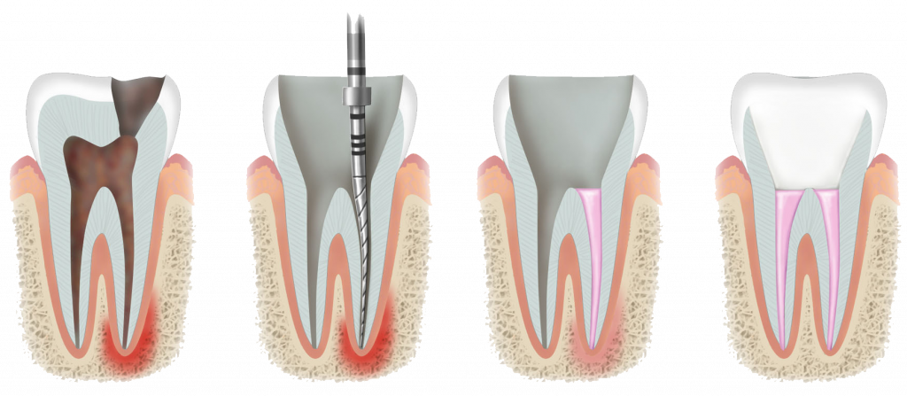 Endodoncia: ¿Qué es y para qué sirve?