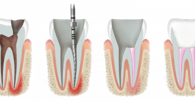 Endodoncia: ¿Qué es y para qué sirve?