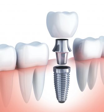 Implantes Dentales: ¿Qué son y para qué sirven?