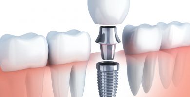 Implantes Dentales: ¿Qué son y para qué sirven?