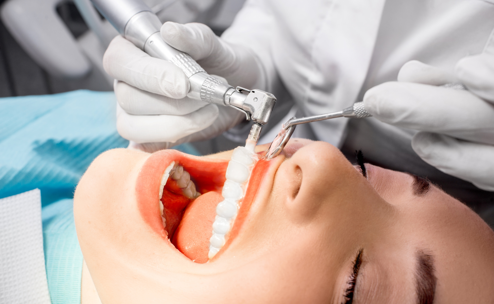Limpiezas Dentales: ¿Qué son y para qué sirven?