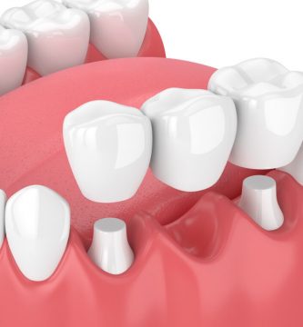 Puentes Dentales: ¿Qué son y para qué sirven?
