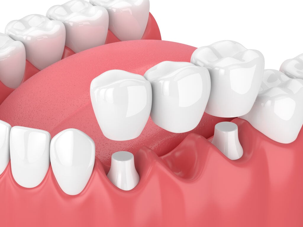 Puentes Dentales: ¿Qué son y para qué sirven?