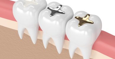 Resinas Dentales: ¿Qué son y para qué sirven?