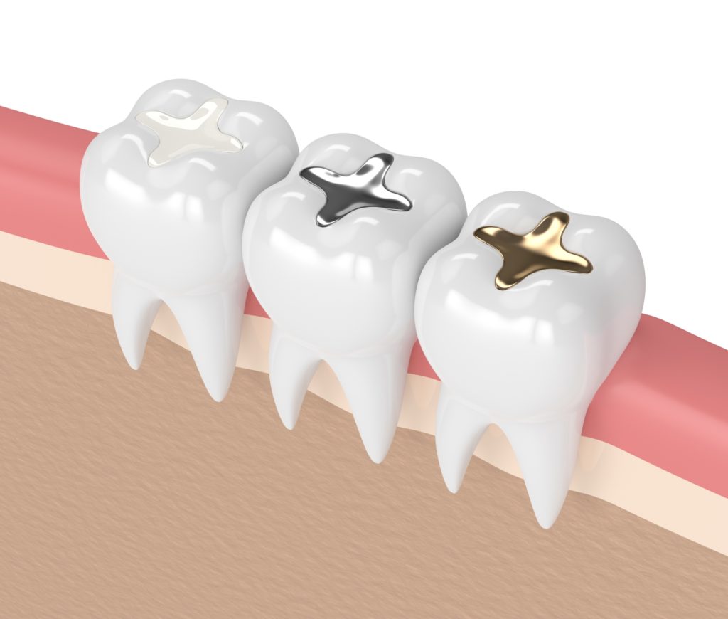 Resinas Dentales: ¿Qué son y para qué sirven?